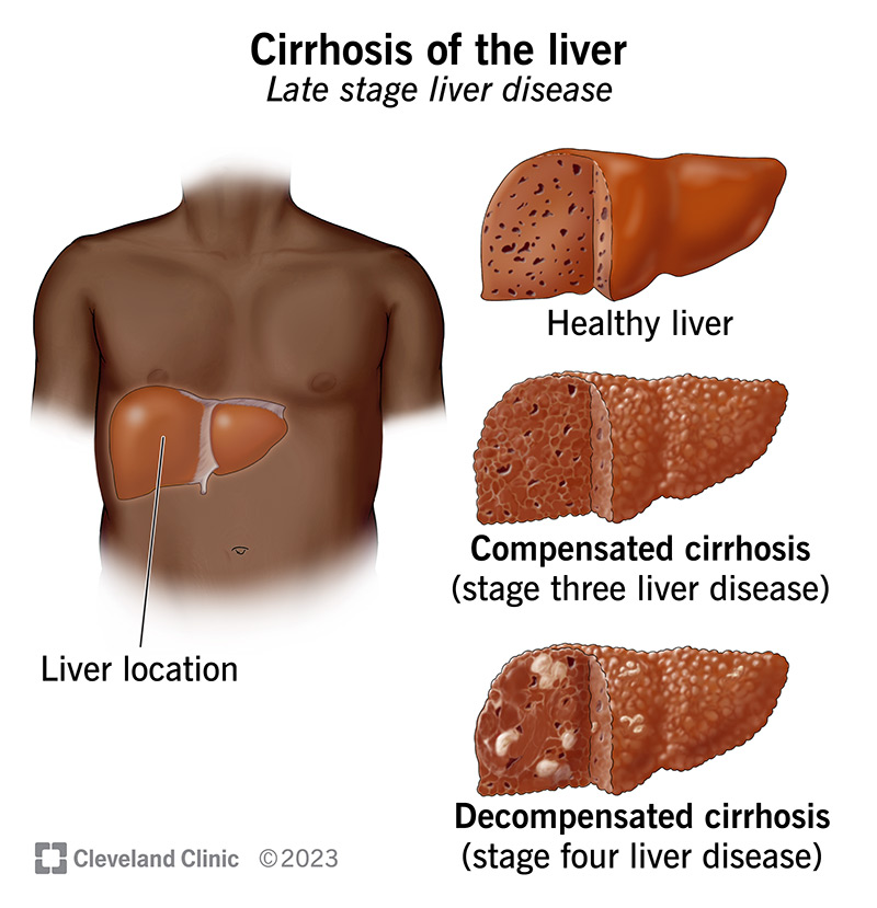 A smooth, healthy liver, a lumpy, damaged liver and a deeply scarred liver, representing end-stage cirrhosis