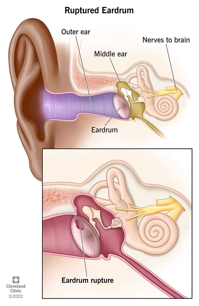 At left – line pointing to outer ear. Below – line pointing to eardrum. Above in the middle – line pointing to middle ear. Far left above – line pointing to nerves to brain. Insert – Below – line pointing to rupture in eardrum.