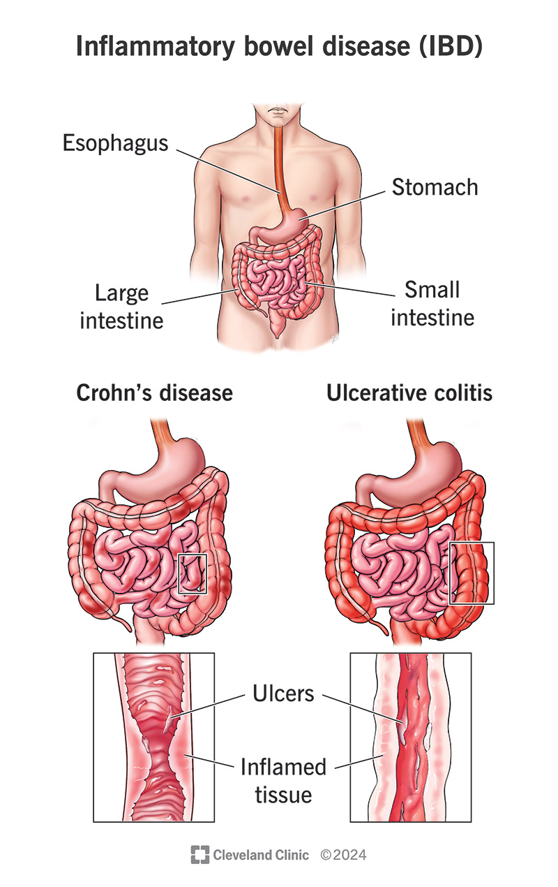 Crohn’s disease (bottom left) and ulcerative colitis (bottom right) are the main types of inflammatory bowel disease (IBD)