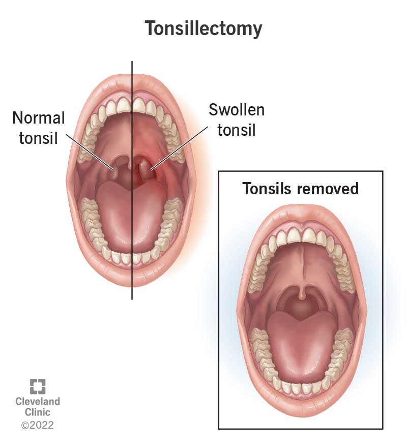 normal tonsils vs infected tonsils