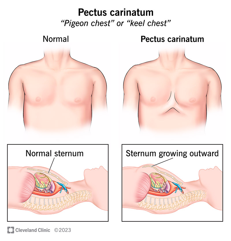 The difference between a normal chest and one with pectus carinatum is a sternum that sticks out.