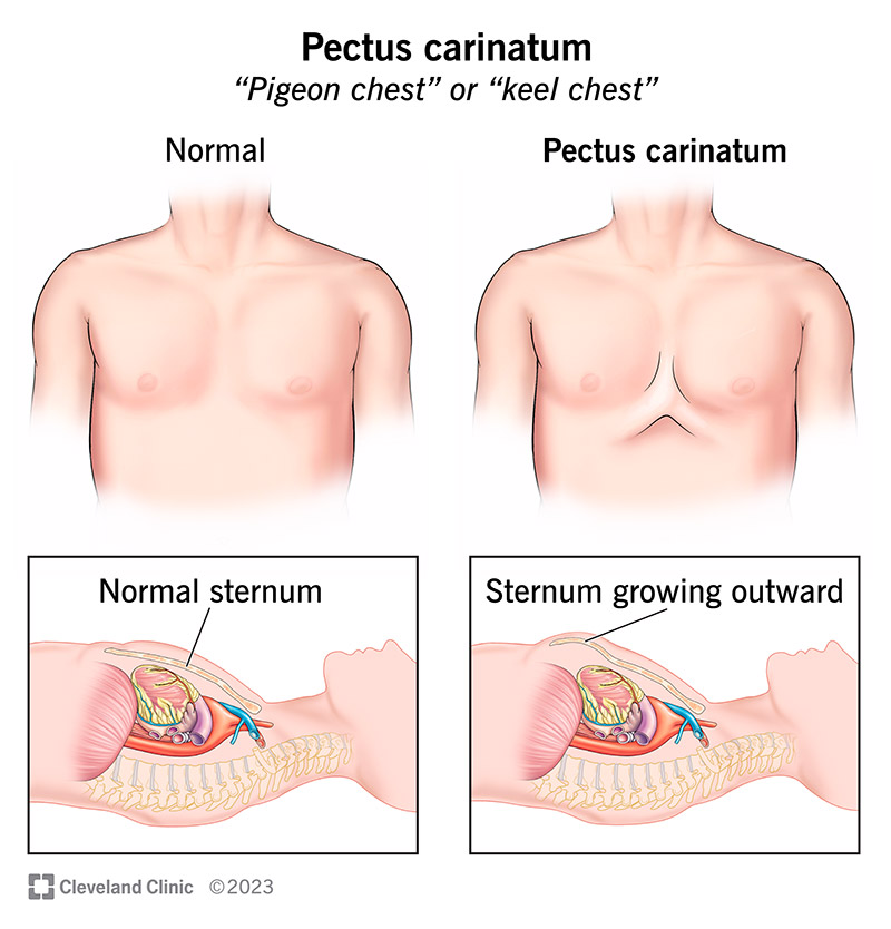 Pectus Carinatum: Causes & Treatments for Chest Wall Disorder