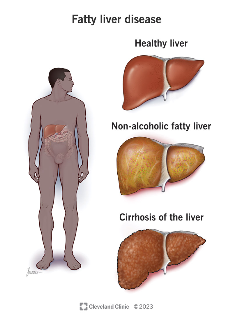 The progression of liver disease: Starting with a healthy liver, then a fatty liver and finally cirrhosis