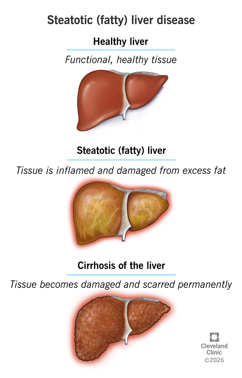 tobacco and fatty liver New insights into why smoking causes disease Abnormal Metabolism in the Progression