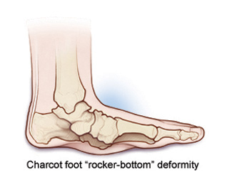 Charcot foot "rocker-bottom" deformity.