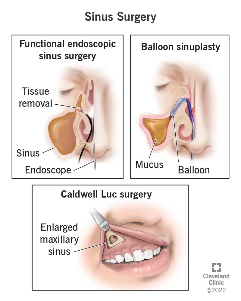 Upper left. Title Functional Endoscopic Sinus Surgery. An endoscope (lower right in image) used to remove infected or disease nasal tissue (middle) to open up sinuses. Upper right. Title Balloon sinuplasty. Balloon used to open blocked passages, releasing mucus trapped in sinus (lower left). Lower center. Title Caldwell Luc surgery. Surgical tool used cut into upper gum line and open up maxillary sinus.