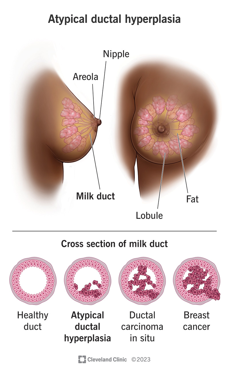 Human breast and nipple showing the milk ducts where abnormal cells can grow in atypical ductal hyperplasia.