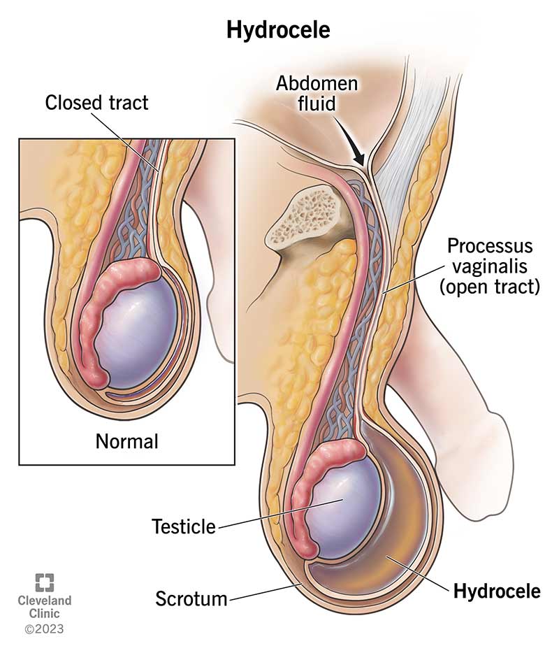 A hydrocele forms when fluid from your abdominal cavity fills a sac in your scrotum. It most often affects fetuses during fetal development.