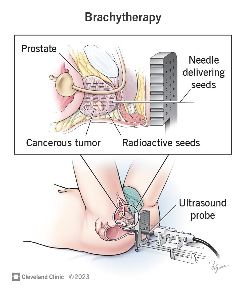 A seed releases radiation near a cancerous lung tumor during brachytherapy A seed releases radiation near a cancerous lung tumor during brachytherapy.