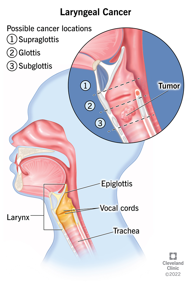 Diagram of the larynx, which shows a tumor forming in the bottom part called the subglottis.