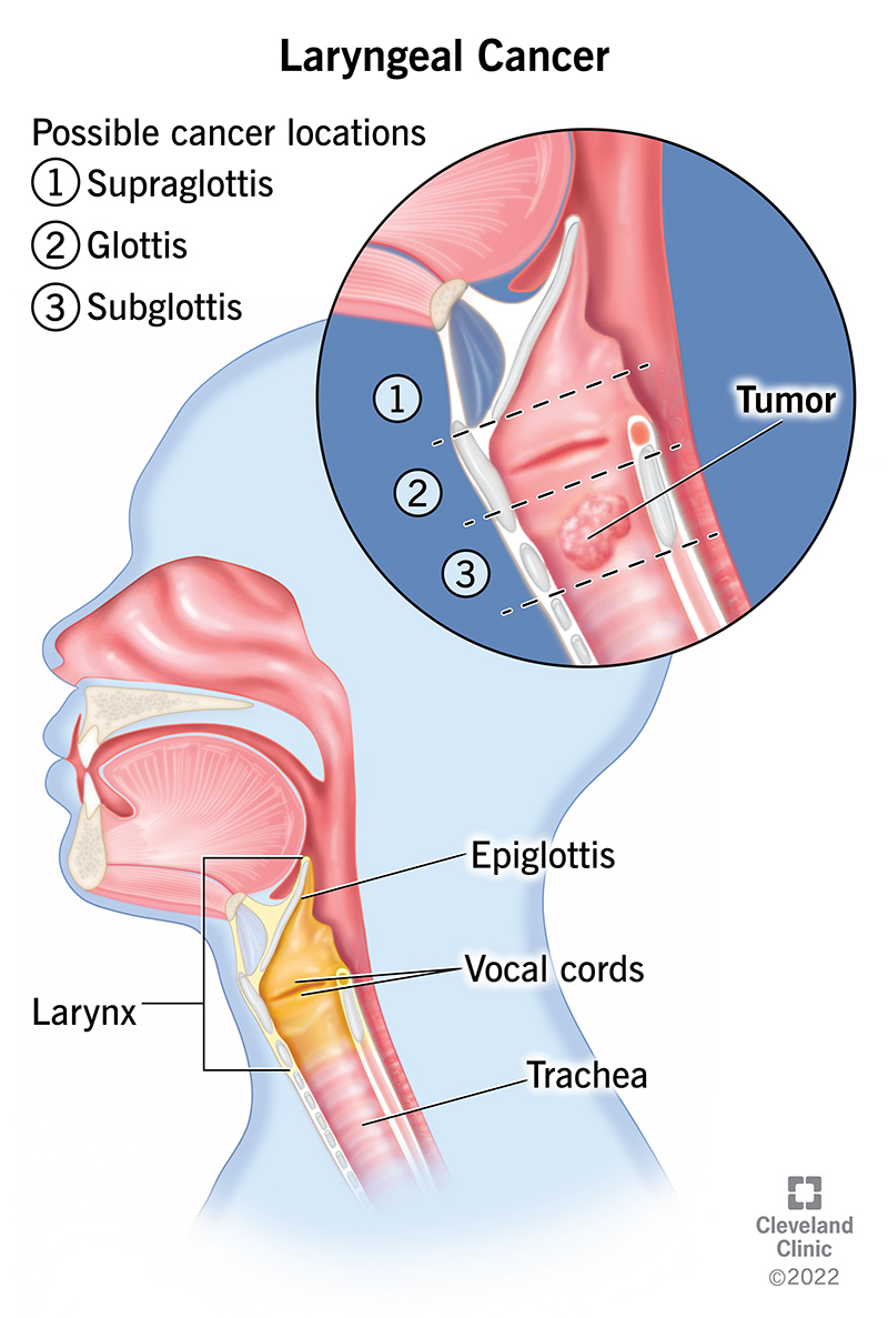 laryngeal cancer nursing case study