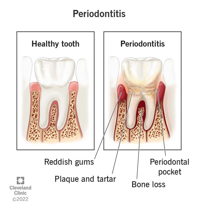 Healthy tooth vs tooth with periodontitis.