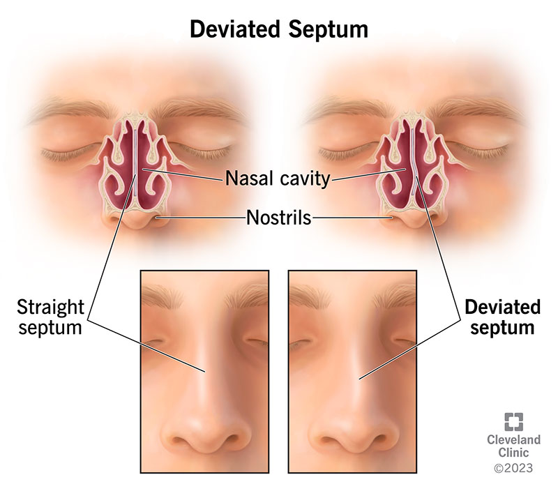 Straight septum vs. deviated septum, internal and external view.