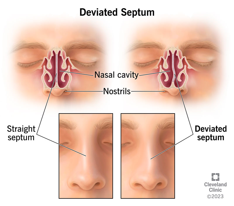 Dry nose deals sinus