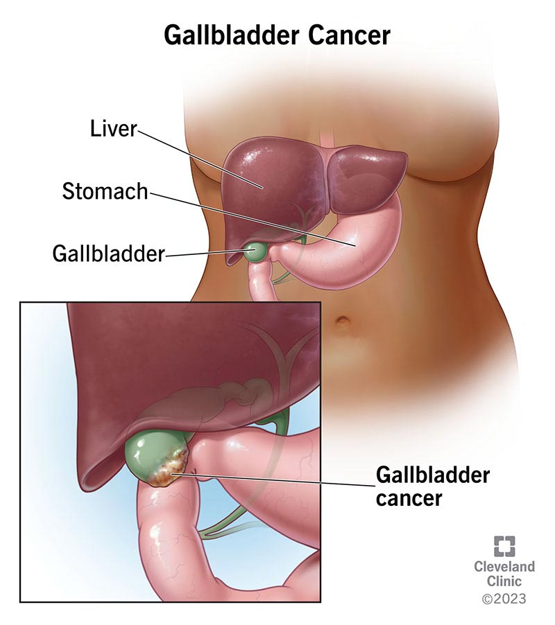 Cancer cells forming at the bottom of the gallbladder.
