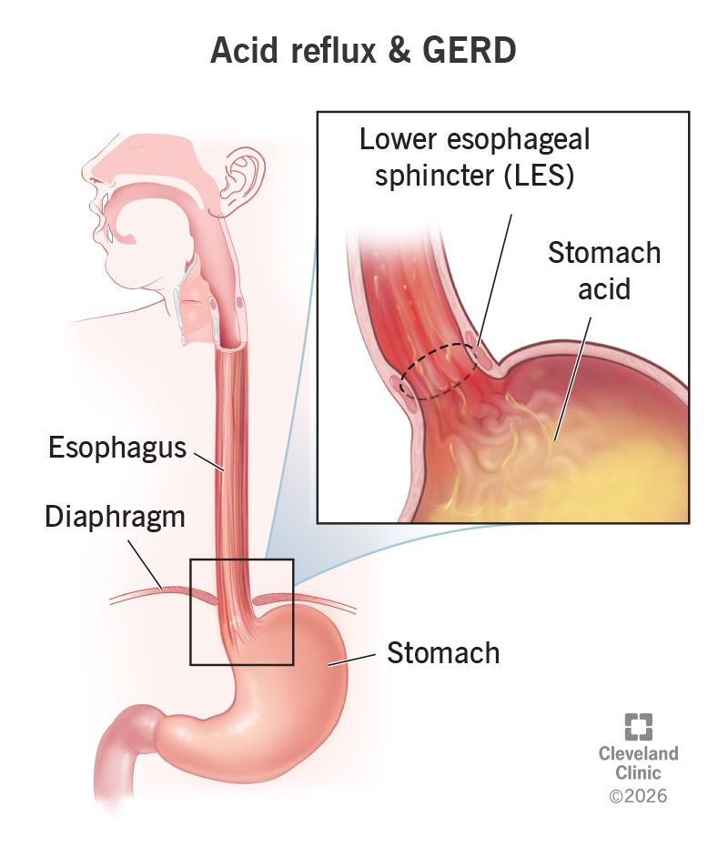Acid reflux and gerd, with stomach acid flowing upward, past the lower esophageal sphincter