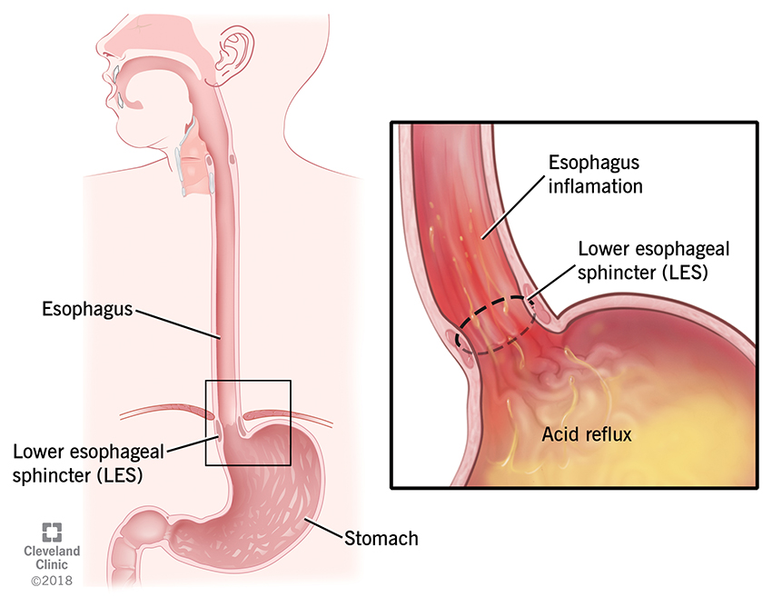 acidity-in-stomach-treatment