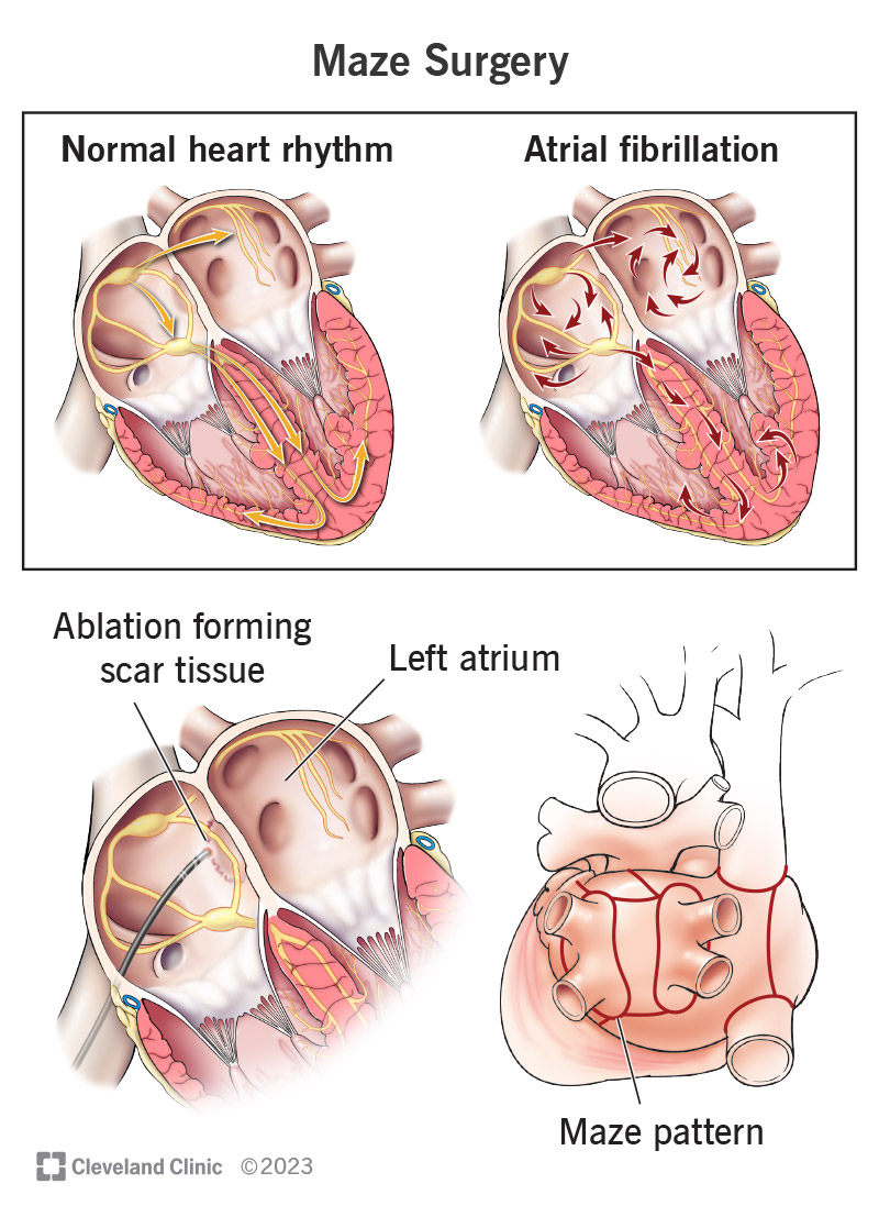 Maze Procedure for Atrial Fibrillation (AFib)