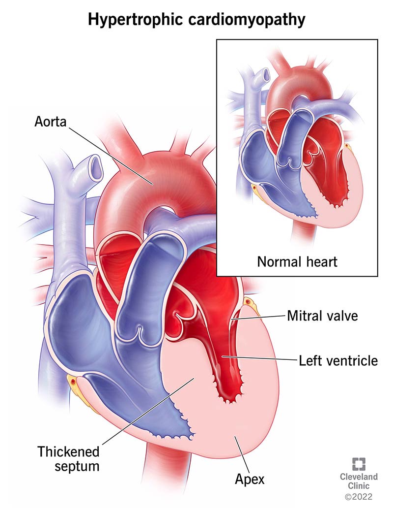 Illustration of hypertrophic cardiomyopathy causing thickened heart muscle.
