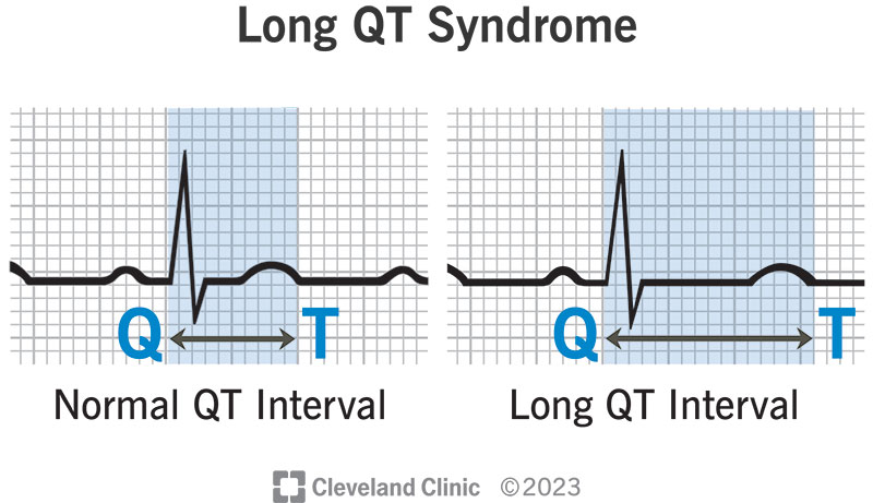 EKGs of a normal QT interval and a long QT interval from Long QT syndrome.
