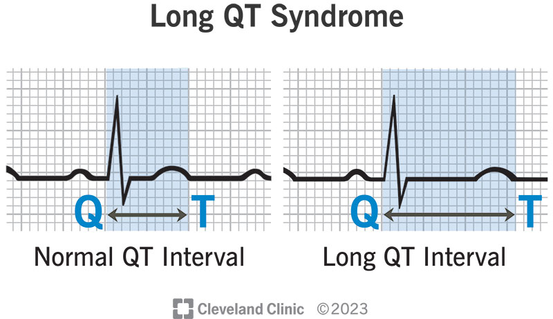 qtc normal range