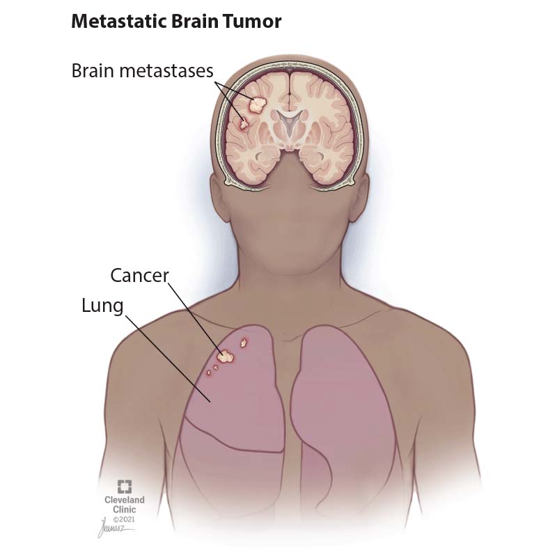 Cancerous tumor in left lung (below) that has metastasized or spread to brain causing brain tumors or brain metastases.