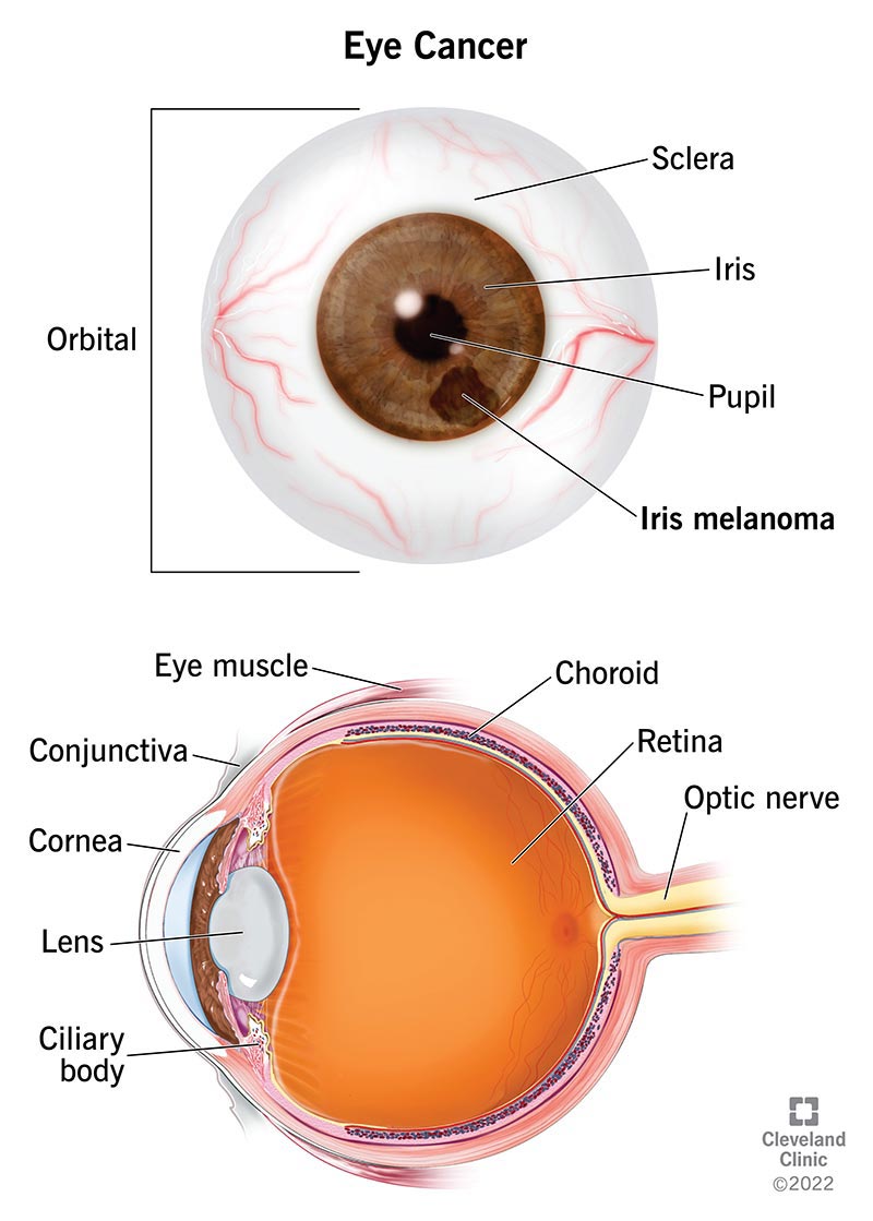 Front and side views of the anatomy of an eyeball with iris melanoma.