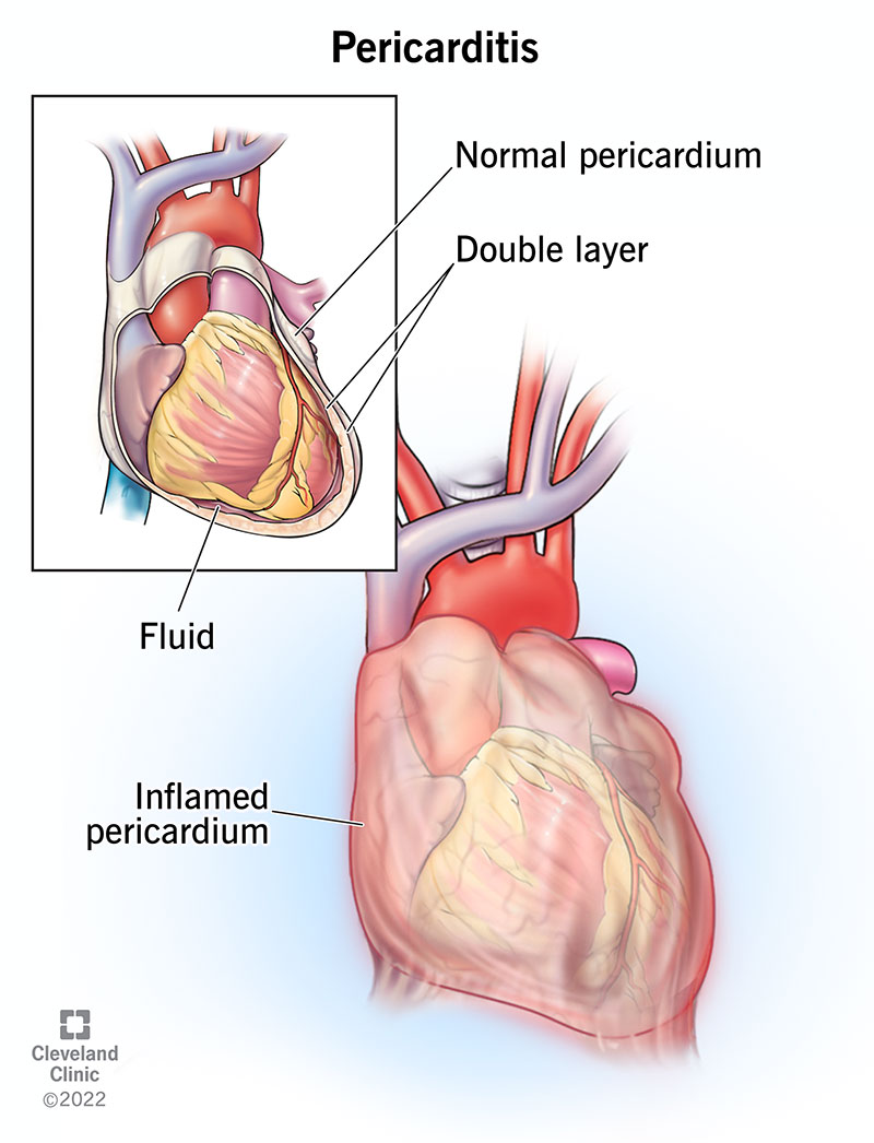 Illustration showing inflamed pericardium.