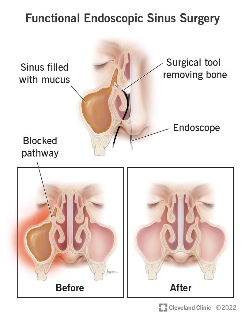 Functional endoscopic sinus surgery (FESS) is a minimally invasive procedure that's used to unblock the sinus openings.