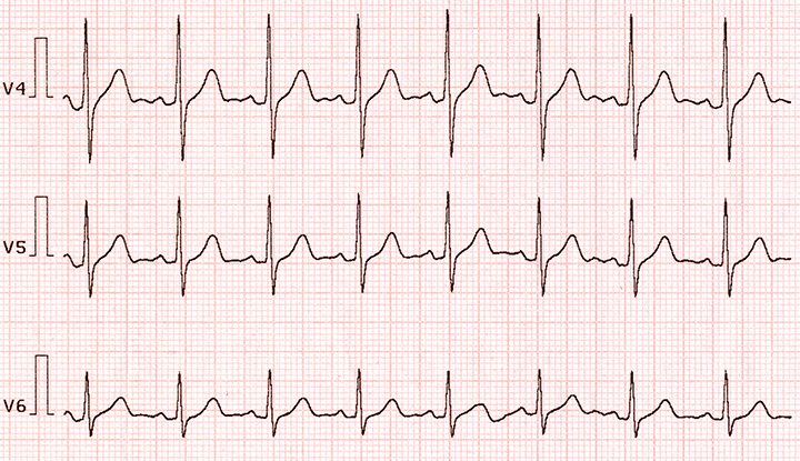 EKG showing ventricular tachycardia.