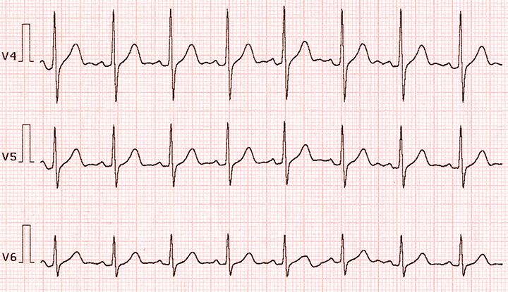 Abnormalities in Rate and Rhythm of Breathing Normal