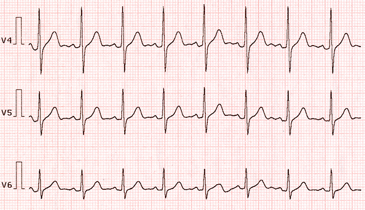 Ventricular Tachycardia Ecg