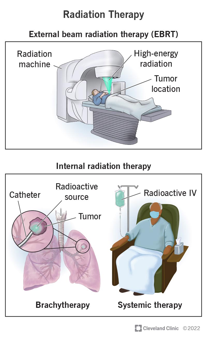 Radiation therapy delivery methods, including EBRT, brachytherapy and systemic therapy