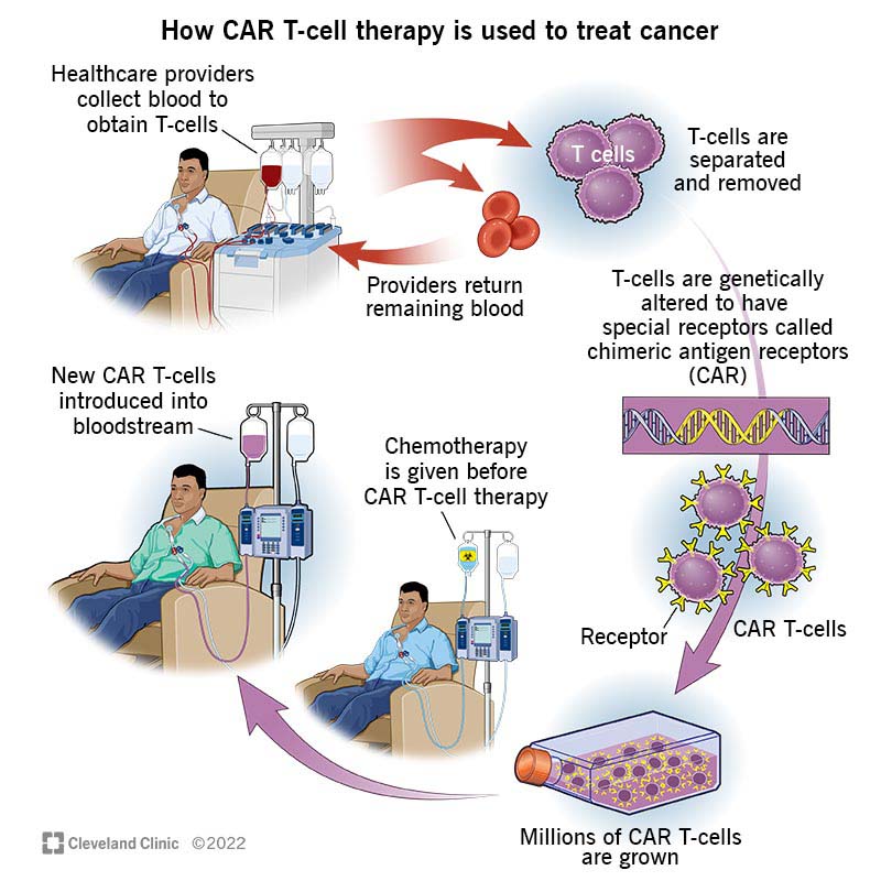 CAR T-cell development process starting with man seated in chair giving blood followed by chemo before receiving therapy.