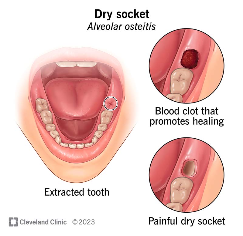 wisdom teeth healing