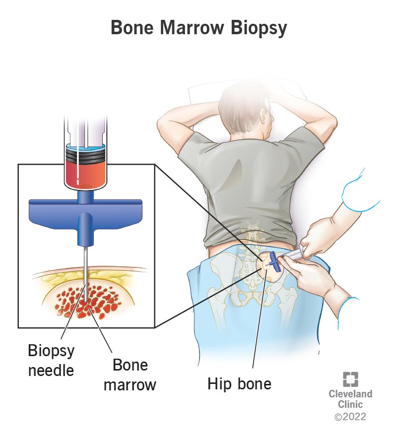 A biopsy needle collecting a bone marrow sample from the hip bone during a bone marrow biopsy