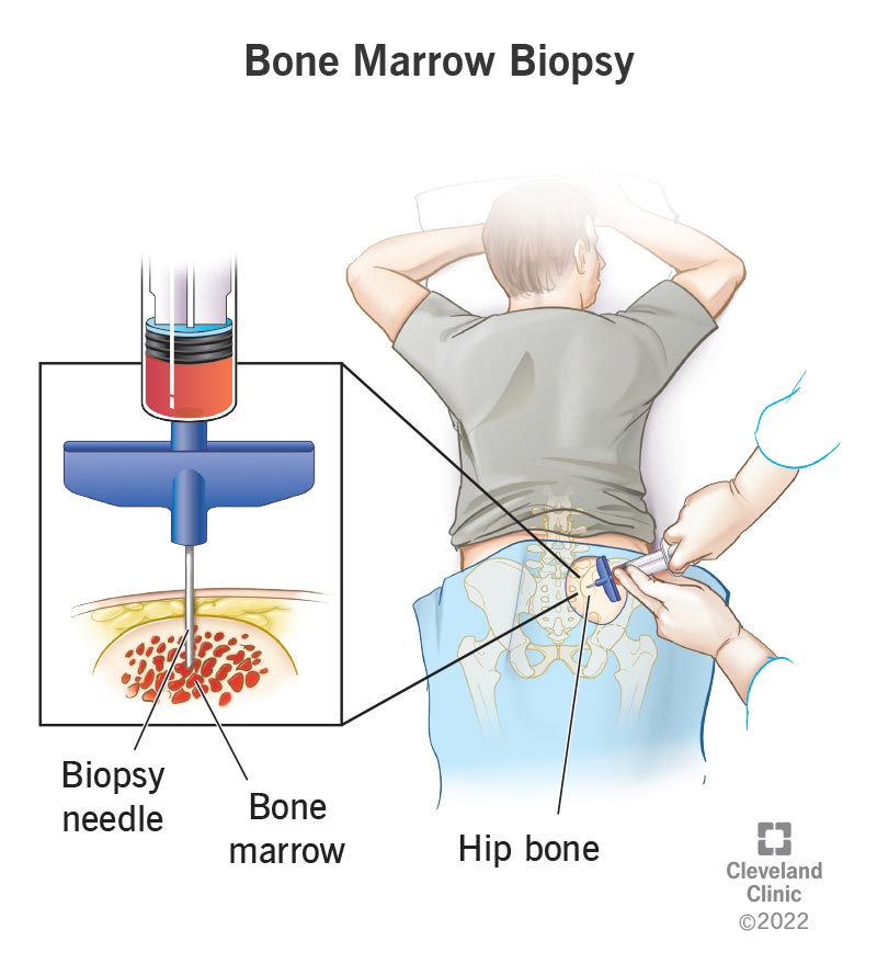 bone marrow diagram leukemia