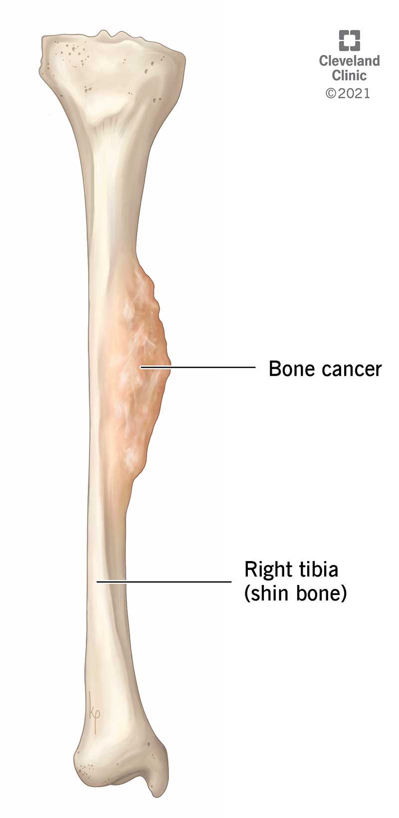Bone cancer is defined as a mass of benign or cancerous cells growing in a bone.