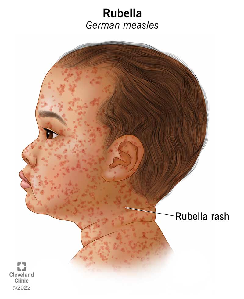 Illustration of rubella rash on a child, showing clusters of small red dots over their face and neck.