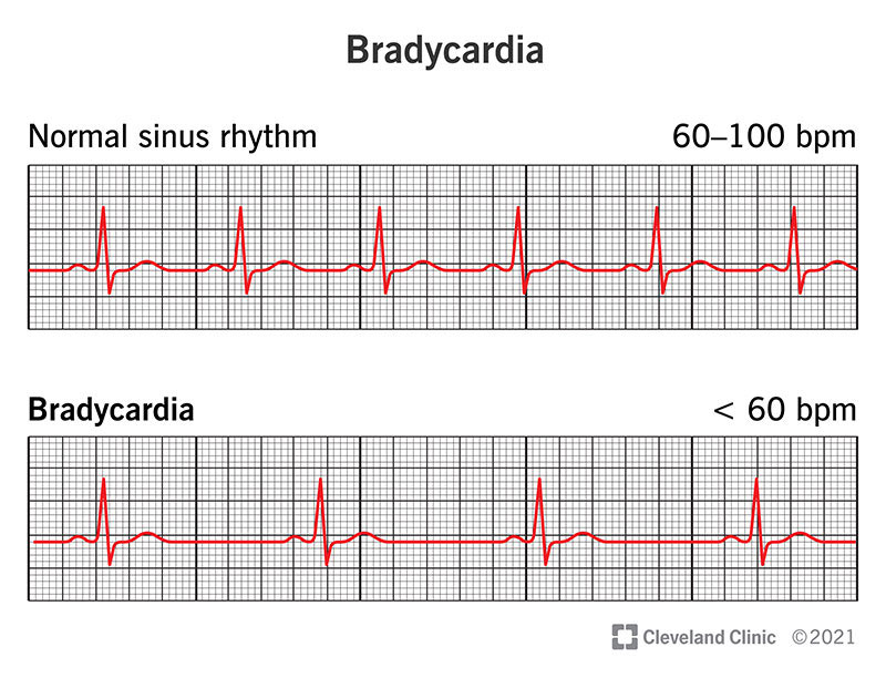 Electrocardiogram showing bradycardia vs a normal heart rhythm.