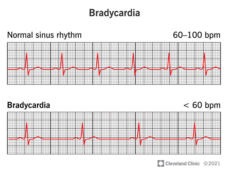 Bradycardia: Symptoms, Causes & Treatment