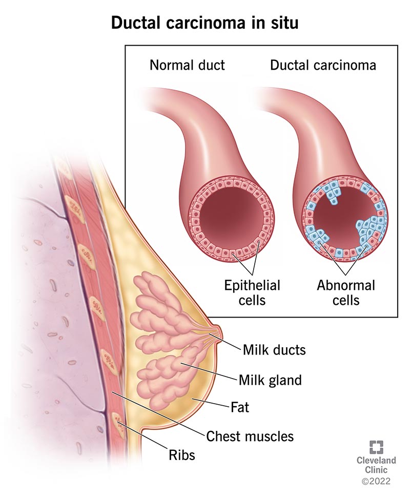 Precancerous cells forming in the milk ducts inside the breast.