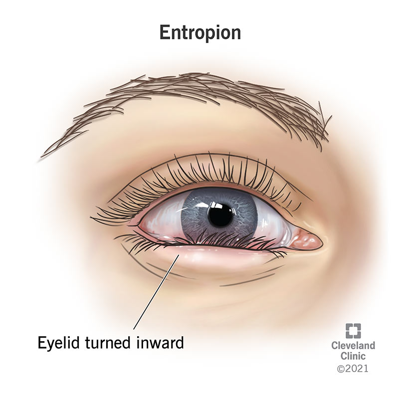 An eye with entropion, where the lower eyelid is turned inward toward the eyeball.