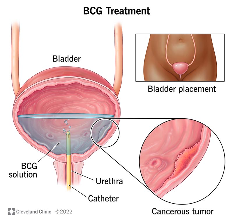 With BCG treatment, your healthcare provider places medication directly inside of your bladder to kill cancer cells.