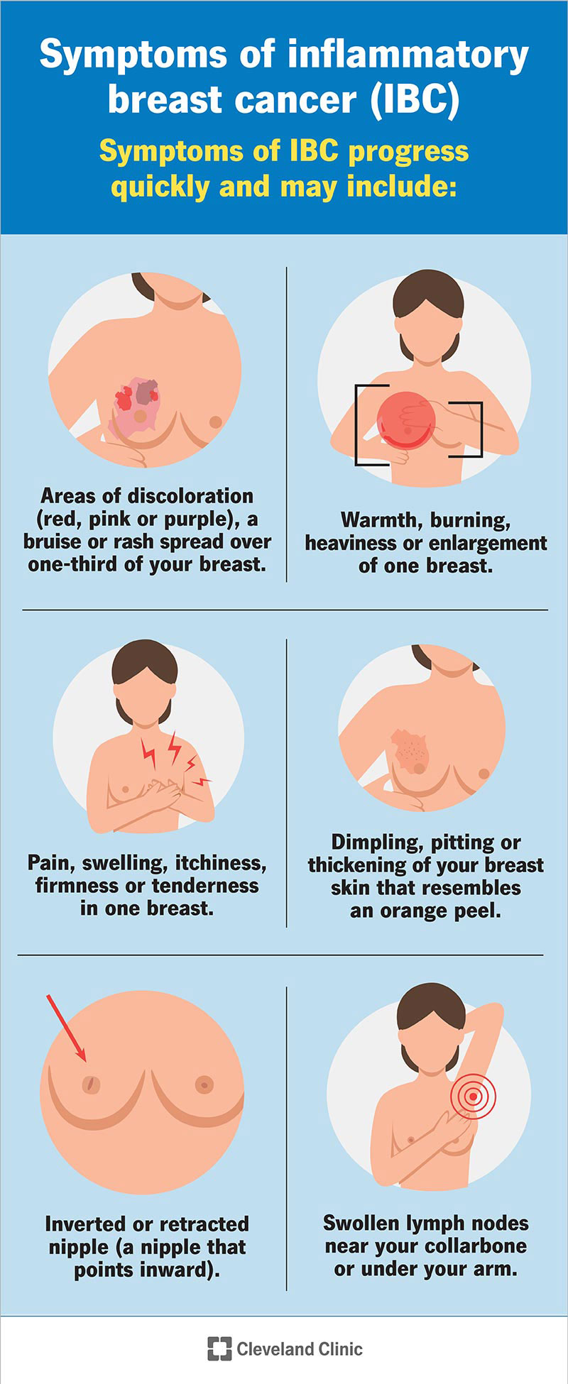 Symptoms of inflammatory breast cancer progress quickly and include changes to your breast skin and nipple.