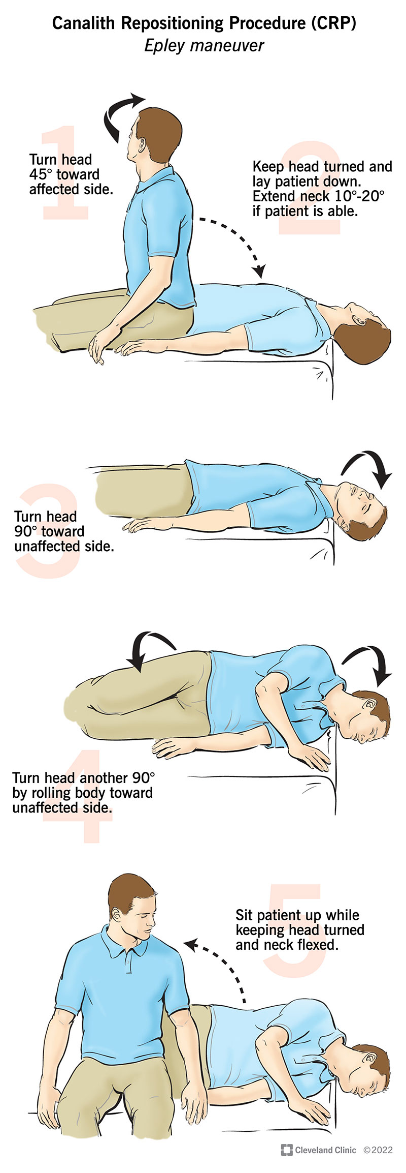 Step-by-step instructions for the Epley maneuver.