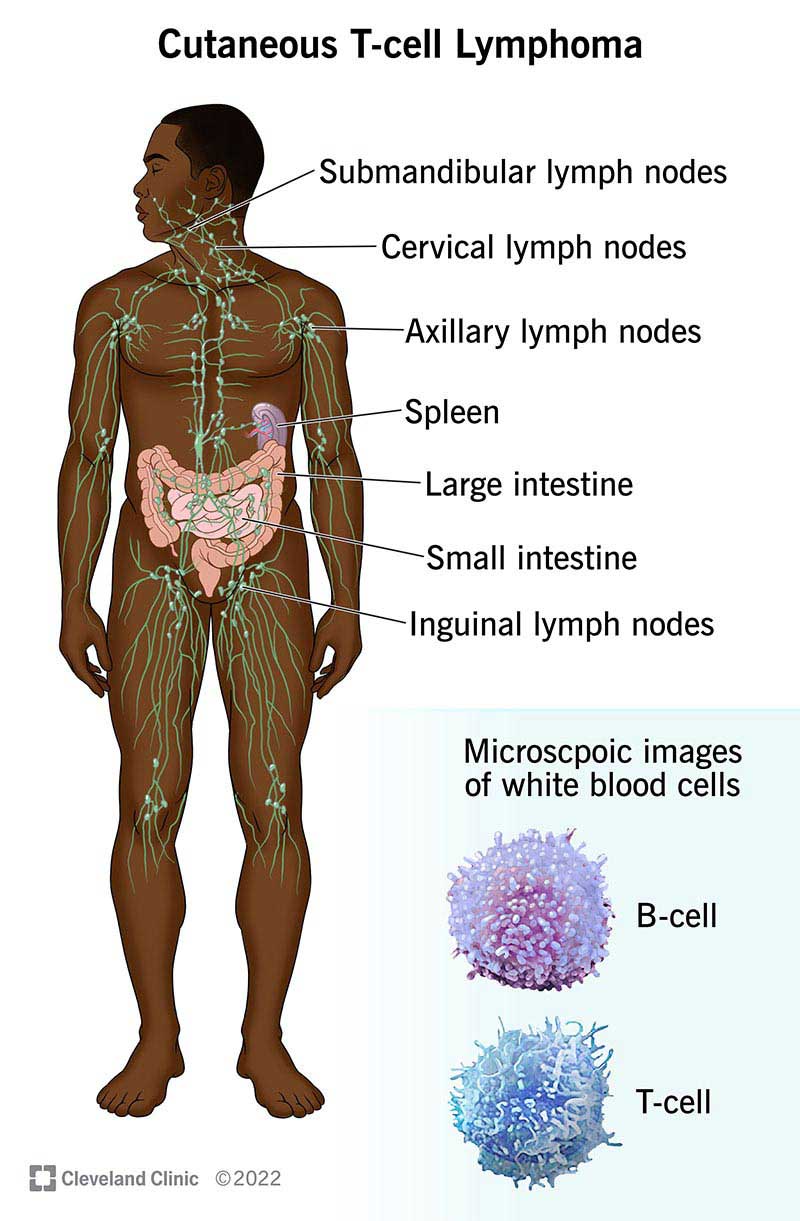 CCutaneous T-cell lymphoma may affect lymph nodes, spleen, large intestine, small intestine and inguinal lymph nodes.