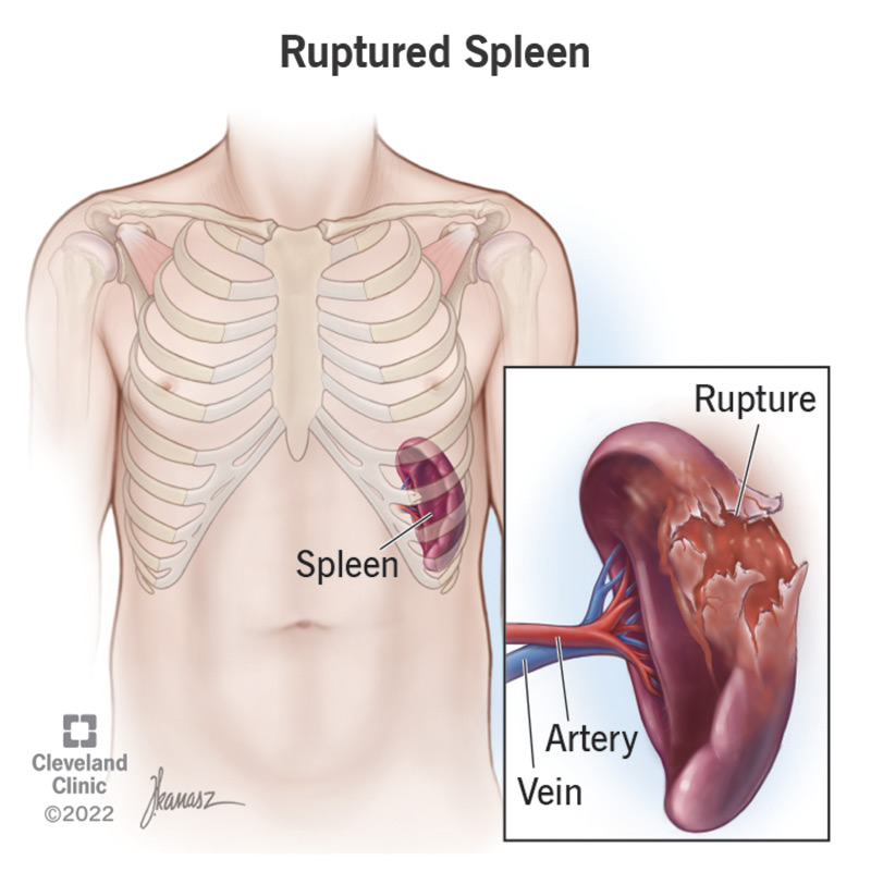 A ruptured spleen is torn in its outer capsule.