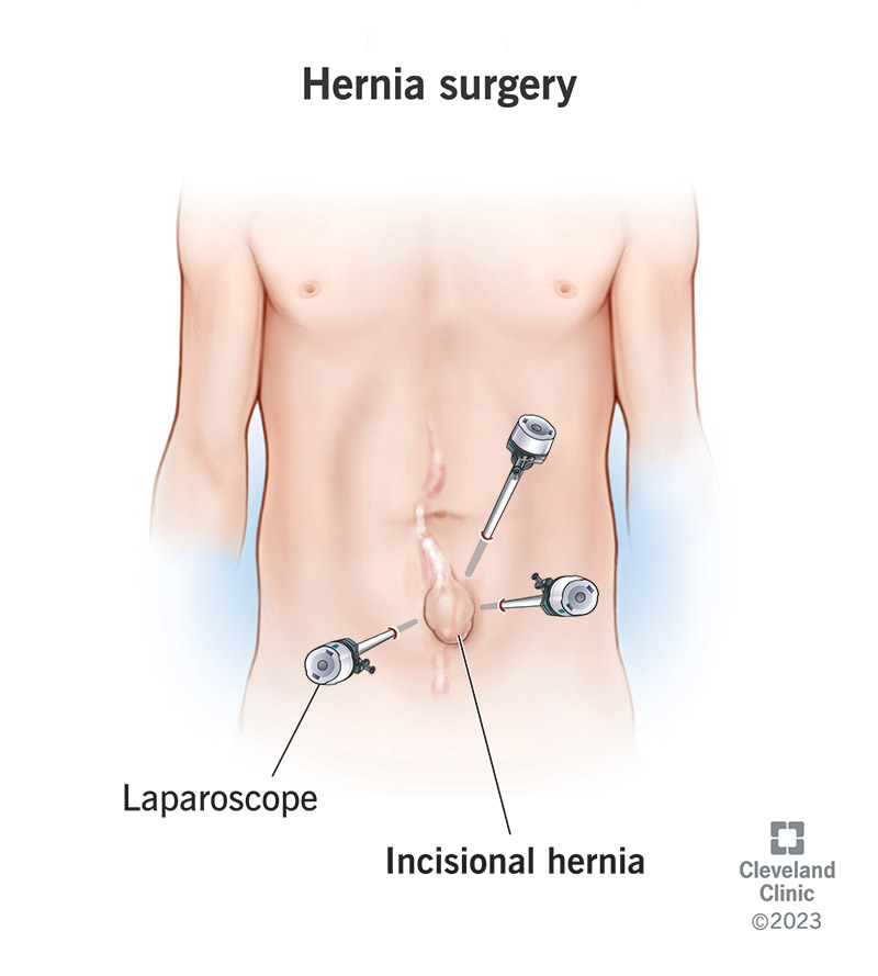 Insertion of three laparoscopes during a laparoscopy to treat an incisional hernia.