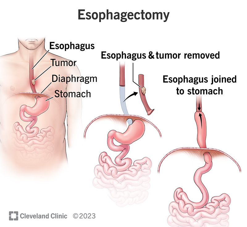 An esophagus before and after an esophagectomy to remove the diseased portion and reconstruct the remaining healthy tissue